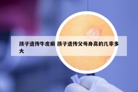 孩子遗传牛皮癣 孩子遗传父母身高的几率多大
