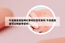 牛皮癣患者能喝红枣枸杞菊花茶吗 牛皮癣患者可以喝姜枣茶吗