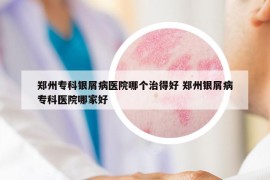 郑州专科银屑病医院哪个治得好 郑州银屑病专科医院哪家好