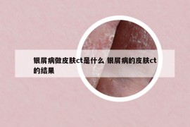 银屑病做皮肤ct是什么 银屑病的皮肤ct的结果