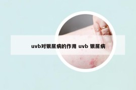 uvb对银屑病的作用 uvb 银屑病