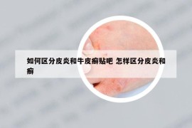 如何区分皮炎和牛皮癣贴吧 怎样区分皮炎和癣