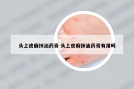 头上皮癣抹油药膏 头上皮癣抹油药膏有用吗
