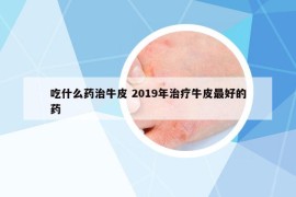 吃什么药治牛皮 2019年治疗牛皮最好的药