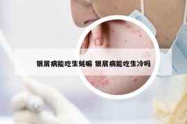 银屑病能吃生蚝嘛 银屑病能吃生冷吗