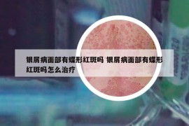 银屑病面部有蝶形红斑吗 银屑病面部有蝶形红斑吗怎么治疗