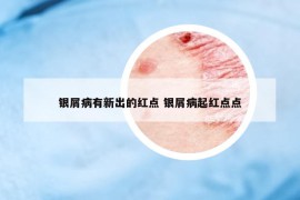 银屑病有新出的红点 银屑病起红点点