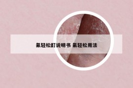氟轻松酊说明书 氟轻松用法