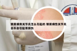 银屑病骨关节炎怎么引起的 银屑病性关节炎会不会引起骨损伤