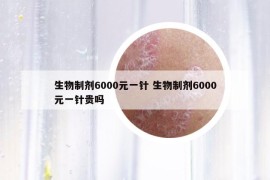 生物制剂6000元一针 生物制剂6000元一针贵吗