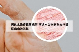 阿达木治疗银屑病群 阿达木生物制剂治疗银屑病功效怎样