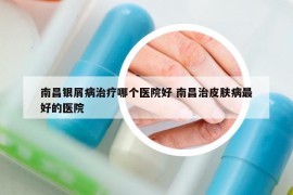 南昌银屑病治疗哪个医院好 南昌治皮肤病最好的医院