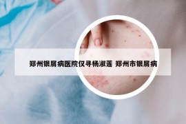 郑州银屑病医院仅寻杨淑莲 郑州市银屑病