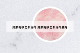 脚脓疱疹怎么治疗 脚脓疱疹怎么治疗最好