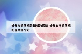 长春治银屑病最权威的医院 长春治疗银屑病的医院哪个好