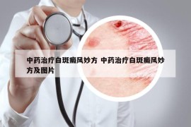 中药治疗白斑癜风妙方 中药治疗白斑癜风妙方及图片