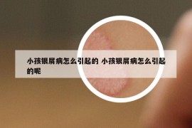 小孩银屑病怎么引起的 小孩银屑病怎么引起的呢