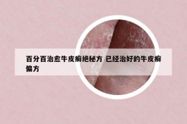 百分百治愈牛皮癣绝秘方 已经治好的牛皮癣偏方