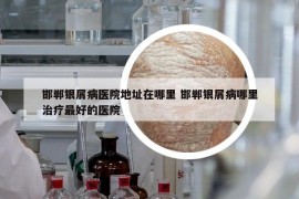 邯郸银屑病医院地址在哪里 邯郸银屑病哪里治疗最好的医院