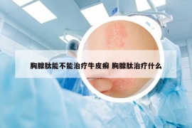 胸腺肽能不能治疗牛皮癣 胸腺肽治疗什么