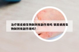 治疗银皮癣生物制剂有副作用吗 银屑病用生物制剂有副作用吗?