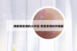 缓解银屑病的小妙招 银屑屑病如何缓解