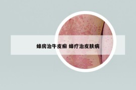 蜂房治牛皮癣 蜂疗治皮肤病