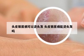 头皮银屑病可以烫头发 头皮银屑病能烫头发吗