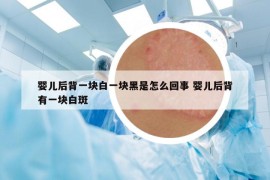 婴儿后背一块白一块黑是怎么回事 婴儿后背有一块白斑