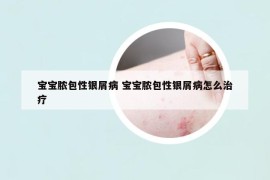 宝宝脓包性银屑病 宝宝脓包性银屑病怎么治疗