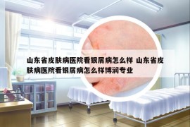 山东省皮肤病医院看银屑病怎么样 山东省皮肤病医院看银屑病怎么样博润专业