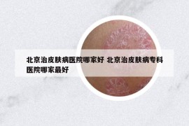 北京治皮肤病医院哪家好 北京治皮肤病专科医院哪家最好