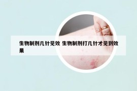 生物制剂几针见效 生物制剂打几针才见到效果