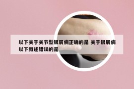 以下关于关节型银屑病正确的是 关于银屑病以下叙述错误的是