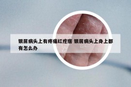 银屑病头上有疼痛红疙瘩 银屑病头上身上都有怎么办