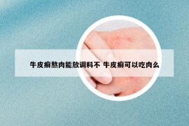 牛皮癣熬肉能放调料不 牛皮癣可以吃肉么