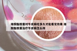 维胺酯胶囊对牛皮癣吃多久才能看见效果 维胺酯胶囊治疗牛皮癣怎么样