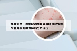 牛皮癣是一型糖尿病的并发症吗 牛皮癣是一型糖尿病的并发症吗怎么治疗