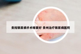 贵阳银屑病手术哪里好 贵州治疗银屑病医院