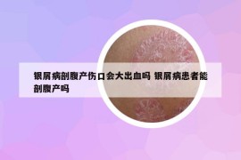 银屑病剖腹产伤口会大出血吗 银屑病患者能剖腹产吗