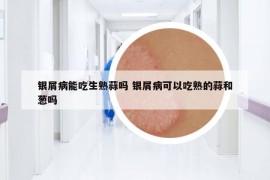 银屑病能吃生熟蒜吗 银屑病可以吃熟的蒜和葱吗