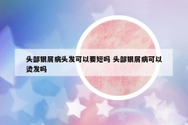 头部银屑病头发可以要短吗 头部银屑病可以烫发吗