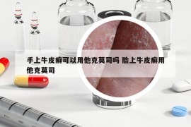 手上牛皮癣可以用他克莫司吗 脸上牛皮癣用他克莫司