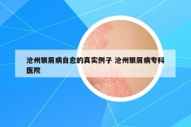 沧州银屑病自愈的真实例子 沧州银屑病专科医院