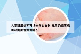 儿童银屑病不可以吃什么食物 儿童的银屑病可以彻底治好好吗?