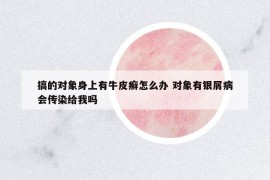 搞的对象身上有牛皮癣怎么办 对象有银屑病会传染给我吗