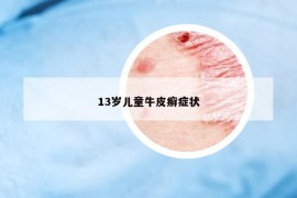 13岁儿童牛皮癣症状