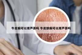 牛皮癣可以用芦荟吗 牛皮肤癣可以用芦荟吗