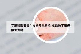 丁苯磷酸乳膏牛皮癣可以用吗 皮炎抹丁苯羟酸会好吗