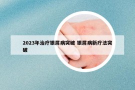 2023年治疗银屑病突破 银屑病新疗法突破